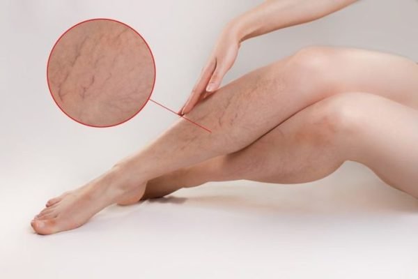The concept of varicose disease and cosmetology. The woman gracefully crosses her legs with vascular stars, runs her hand over them. The enlarged image of blood vessels